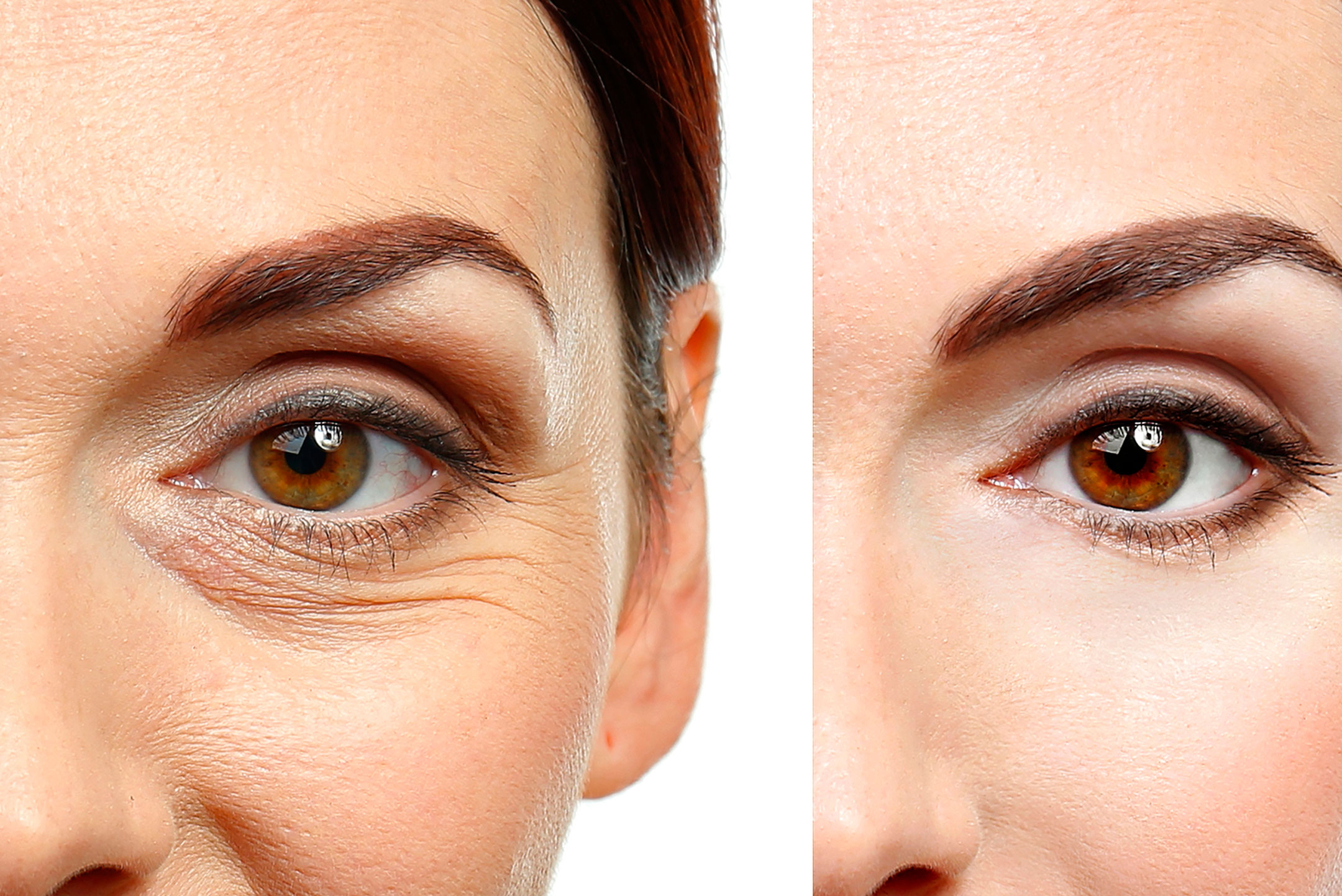 EYELID SURGERY (BLEPHAROPLASTY)