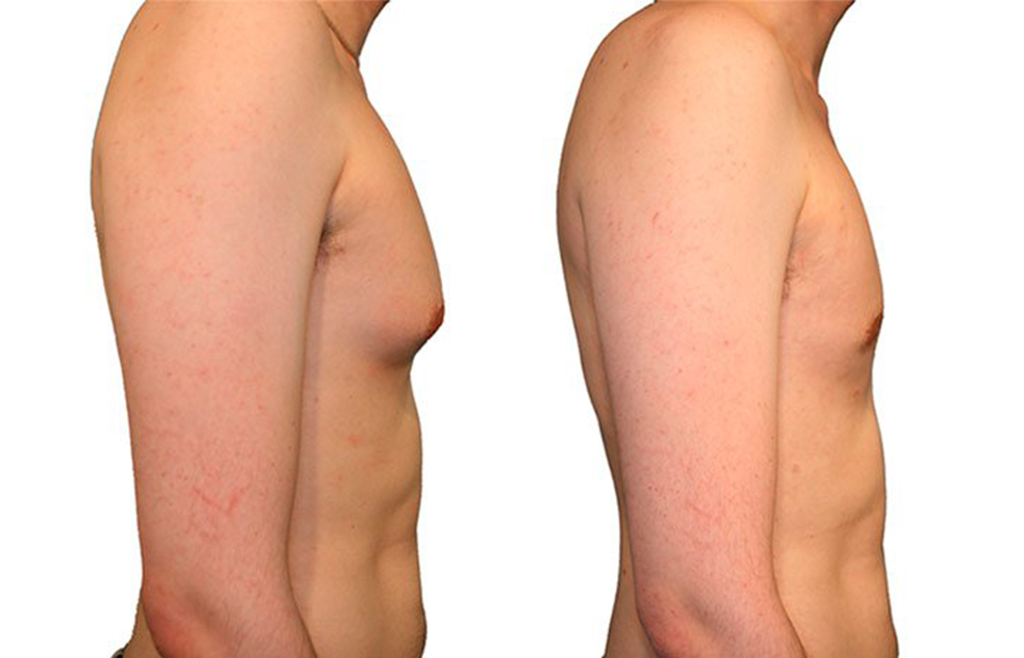Gynecomastia or Reduction of the Male Breast